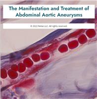 The Manifestation and Treatment of Abdominal Aortic Aneurysms