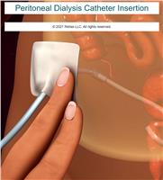 Peritoneal Dialysis Catheter Insertion